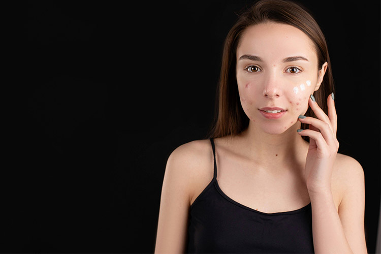 Apple cider vinegar as a remedy for acne